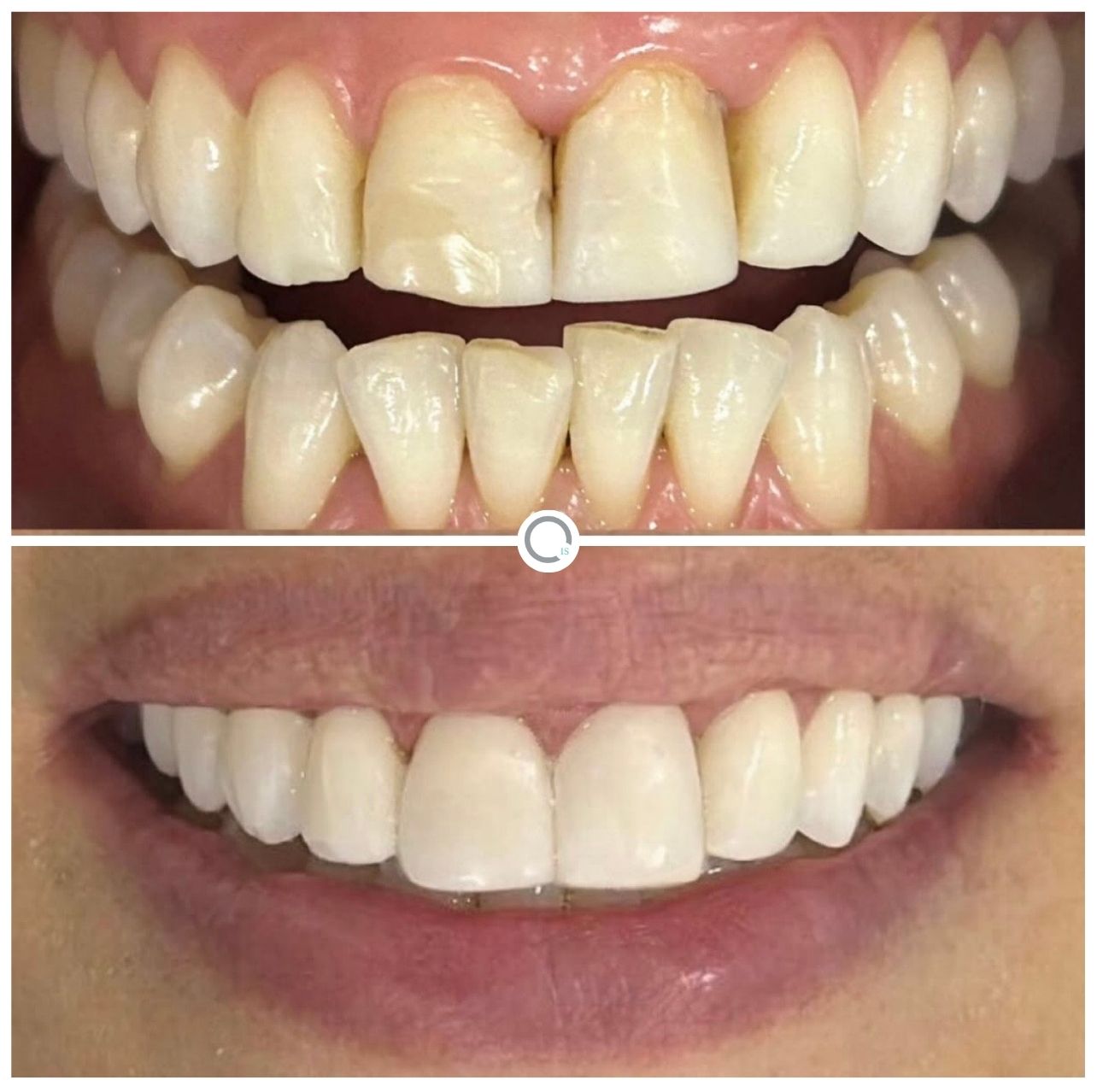 Caso de Éxito 1 - Implants & Smiles