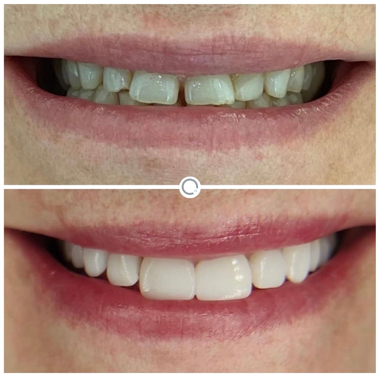 Caso de Éxito 3 - Implants & Smiles