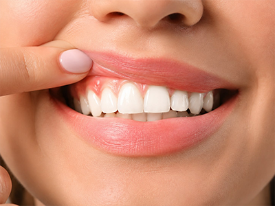 Periodoncia